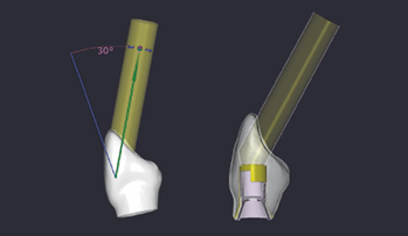 Angled screw-access CAD example
